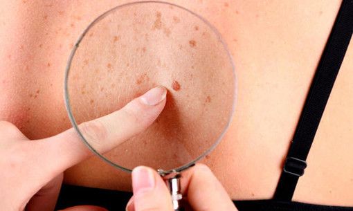 C’è uno strumento innovativo per la diagnosi precoce dei tumori della pelle C’è uno strumento innovativo per la diagnosi precoce dei tumori della pelle