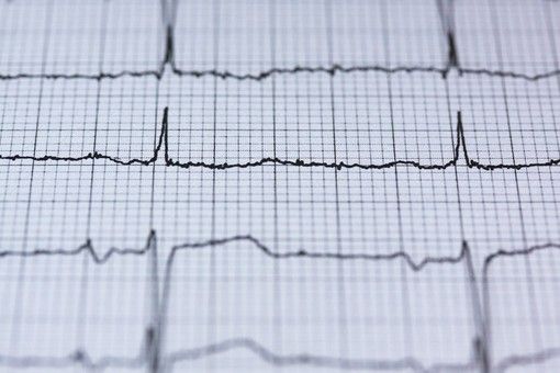 Installata una strumentazione unica in Italia contro l’ictus all’ospedale Garibaldi di Catania Installata una strumentazione unica in Italia contro l’ictus all’ospedale Garibaldi di Catania