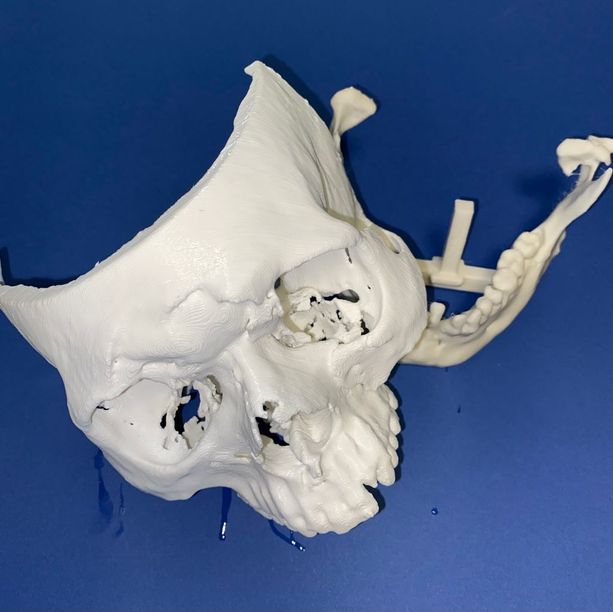 Capolavoro di ingegneria alla Città della Salute: ricostruito in urgenza un volto in 3D per un 23enne con un trauma facciale