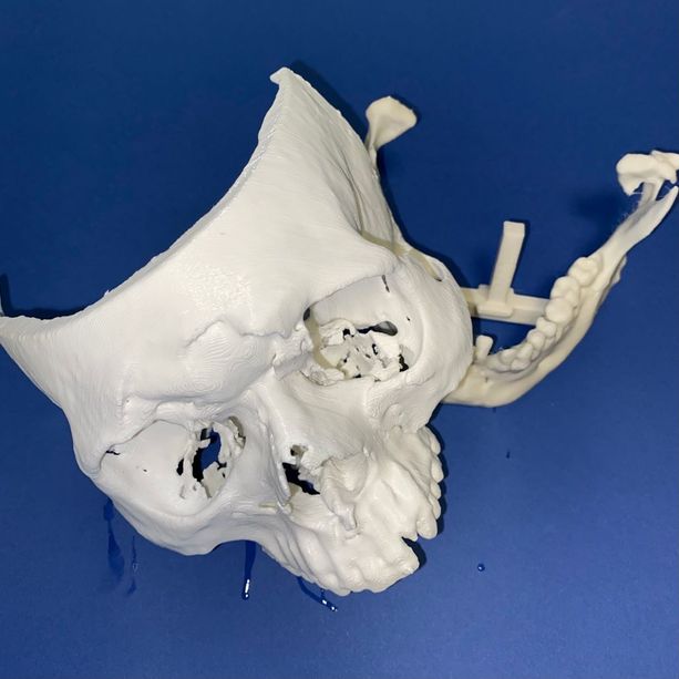 Capolavoro di ingegneria alla Città della Salute: ricostruito in urgenza un volto in 3D per un 23enne con un trauma facciale