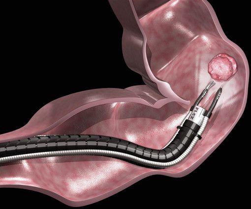Nuova campagna europea per la prevenzione del tumore del colon e del retto