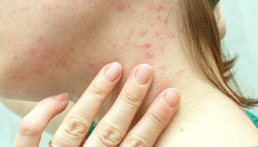 Vaiolo delle scimmie causa morti in Africa, Oms dichiara emergenza sanitaria internazionale