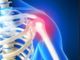 Nuove tecniche mini-invasive danno ottimi risultati per le lesioni alla spalla