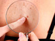 C’è uno strumento innovativo per la diagnosi precoce dei tumori della pelle