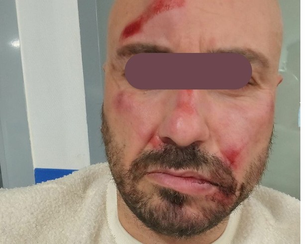 Aggredito in strada da due giovani in monopattino: "Mi hanno spruzzato lo spray e rubato lo smartwatch"