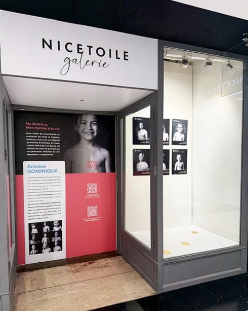 La cicatrice che non si nasconde: a Nice il cuore racconta la vita